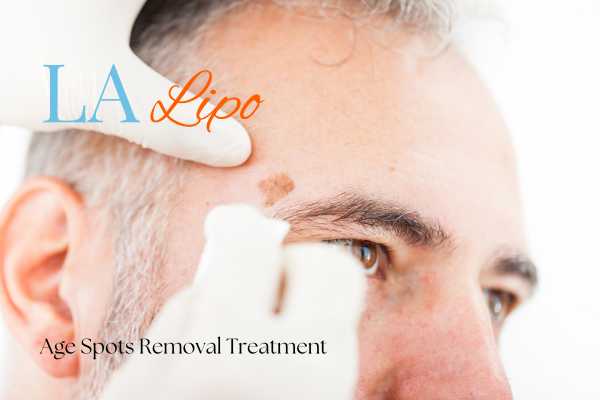What Are the Most Effective Treatments for Age Spots West Kensington?