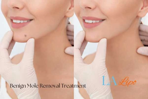 woman's before and after mole removal West Kensington results