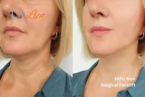 hi-fu for wrinkles West Kensington before and after results