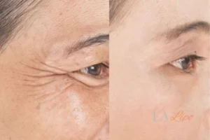 Before and after results of woman - HI-fu wrinkles reduction treatment West Kensington