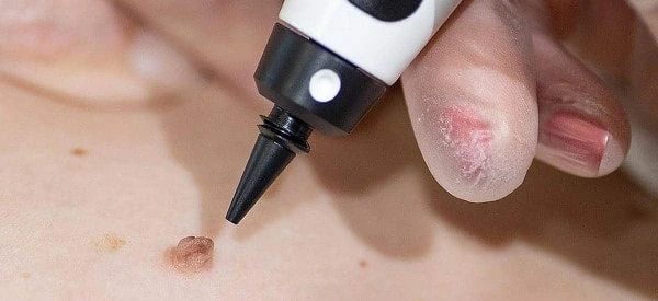 skin tag removal using cryopen West Kensington