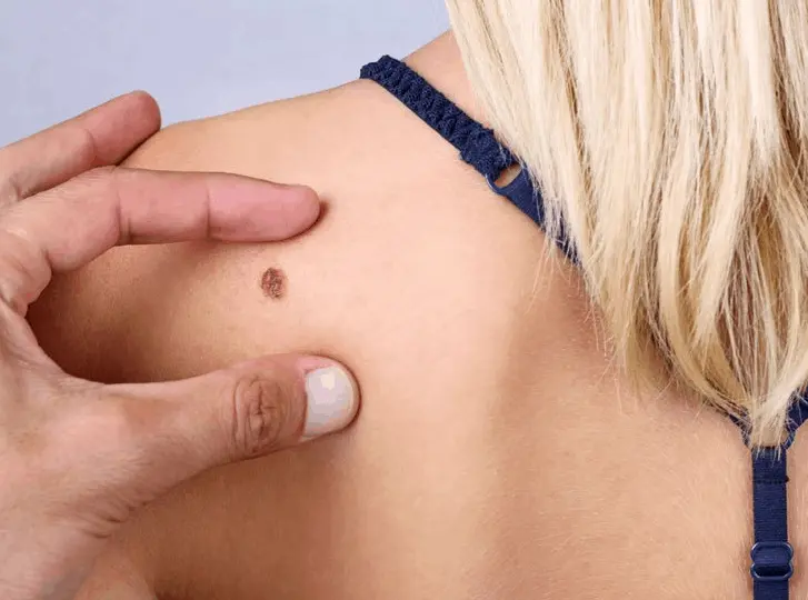 woman having mole removal West Kensington consultation before treatment.