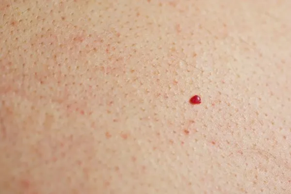 close up of a cherry angioma West Kensington