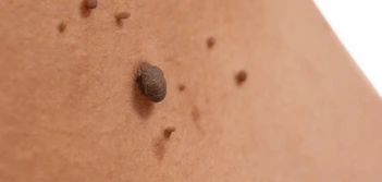 image of a skin tag West Kensington