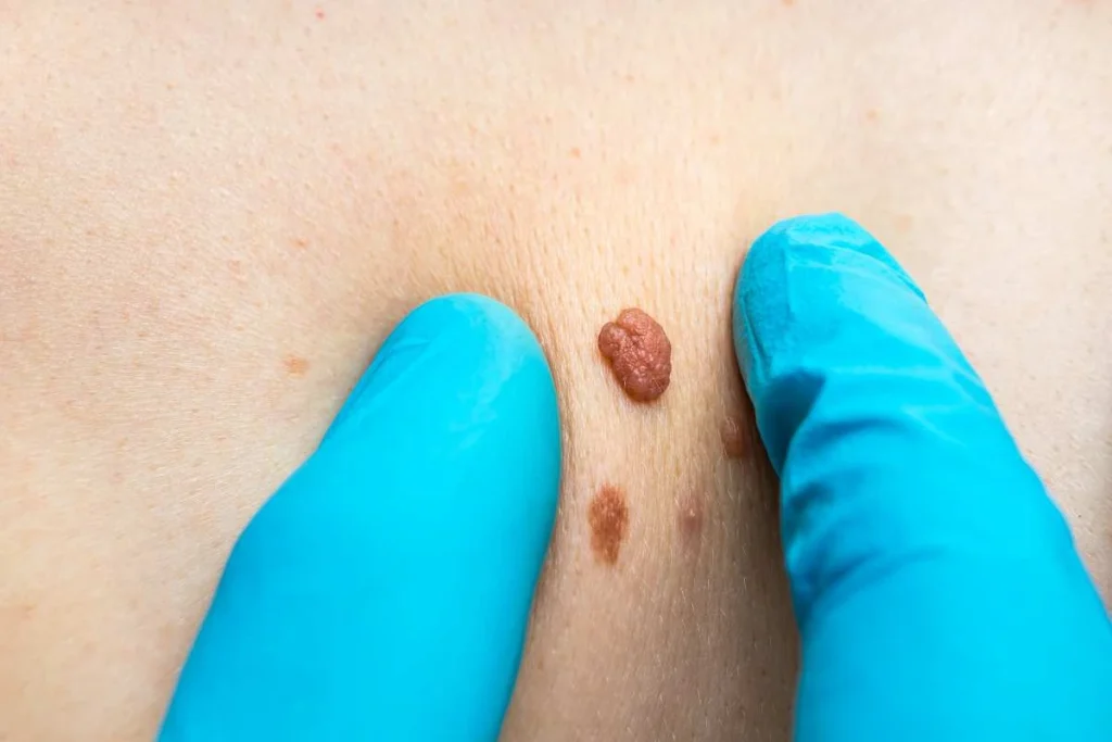 Consultant examining a skin tag West Kensington