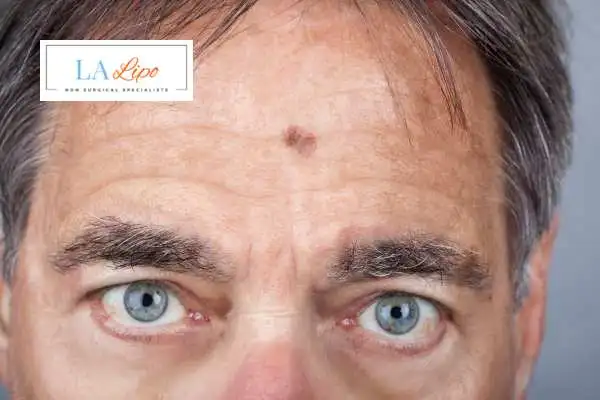 Solar Lentigo Removal West Kensington image of man with mark on his forehead