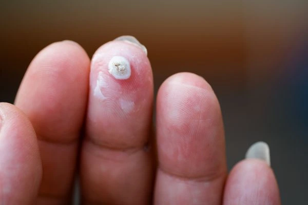 wart on person finger - cryotherapy to treat from LA LIPO West Kensington