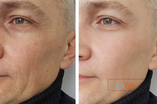 See the amazing results of Morpheus8 Treatment West Kensington!