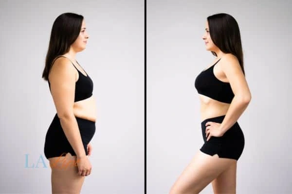 Picture of womans before and after using LA-EMS body sculpting to improve her core strength West Kensington