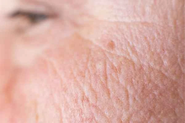 close up picture of a woman's face showing an age spot West Kensington