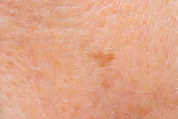 close up picture of age spots West Kensington