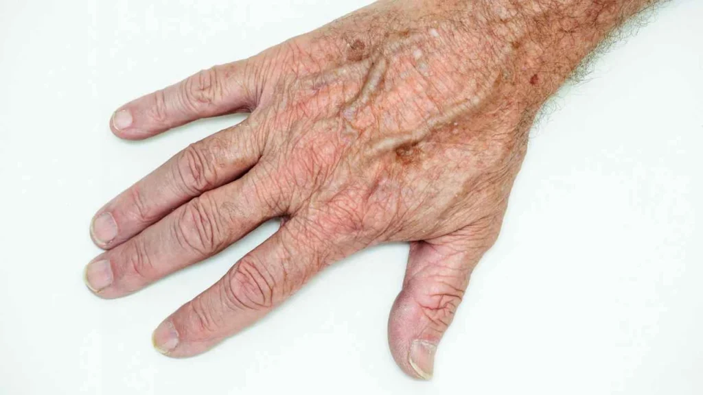 Male hand showing age spot West Kensington