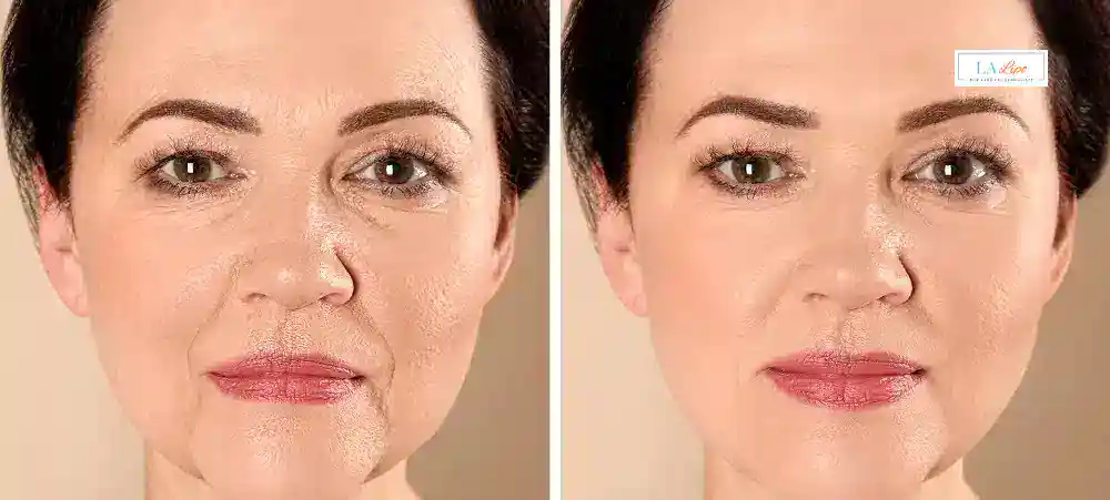 How Long Does It Take to See Results and How Long Do They Last West Kensington?